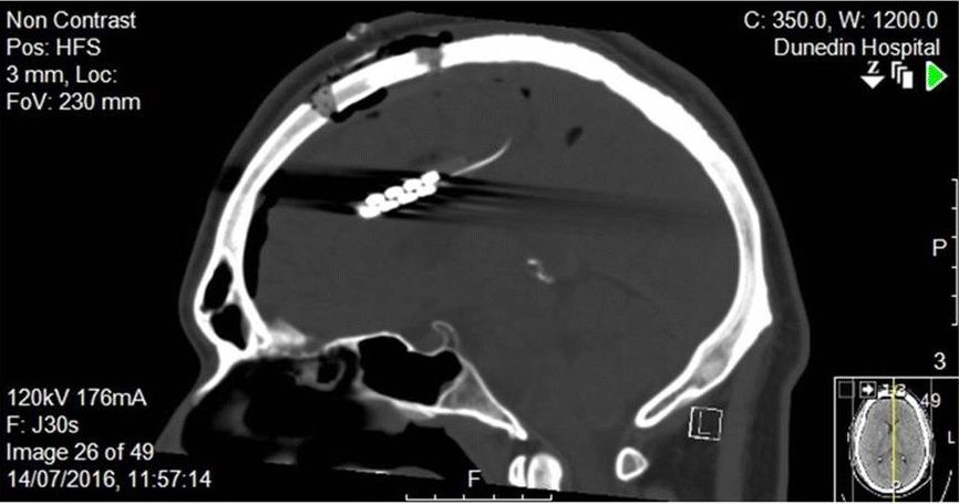 Implanted electrodes in the rostrodorsal anterior cingulate cortex (rdACC) for alcoholism treatment. (Credit: Sook Ling Leong et al., 2020, Neurotherapeutics)